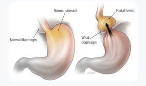 HARS-17-Hiatus-Hernia (1)